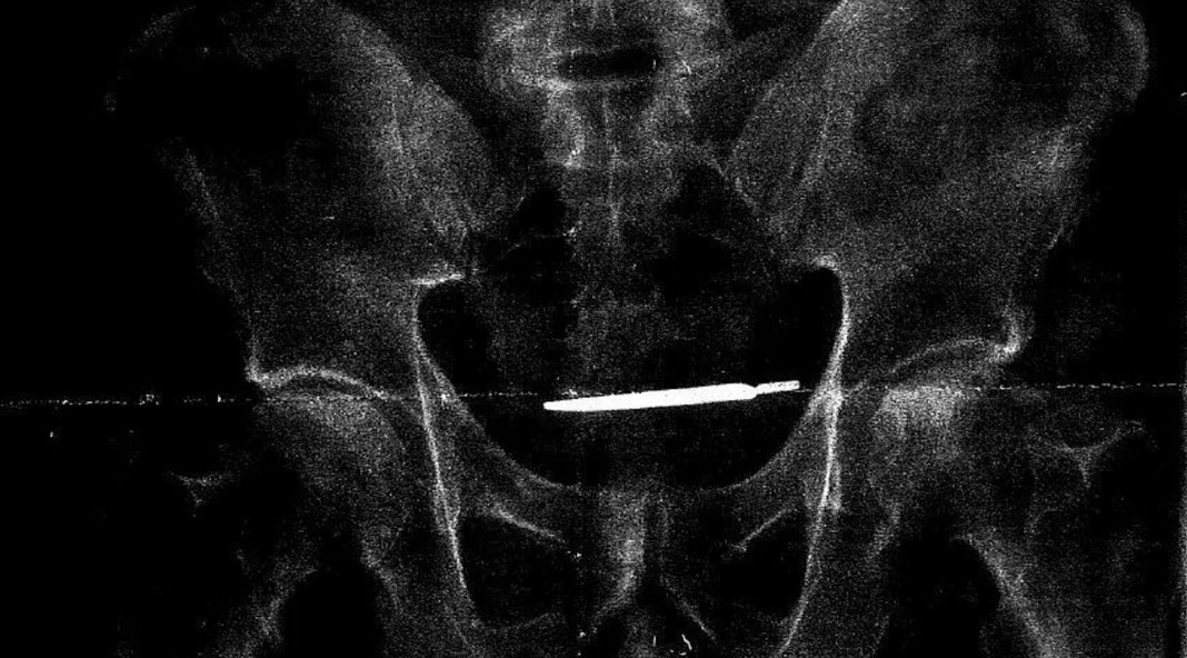 scalpel found in Patient 4 years later